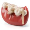 Omnia One Dental Wooden Wedges Disposable Medium White Pack 100-2