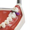 Shuodi Plastic Orthodontic Matrix Wedge Set with Stainless Steel Knife-3